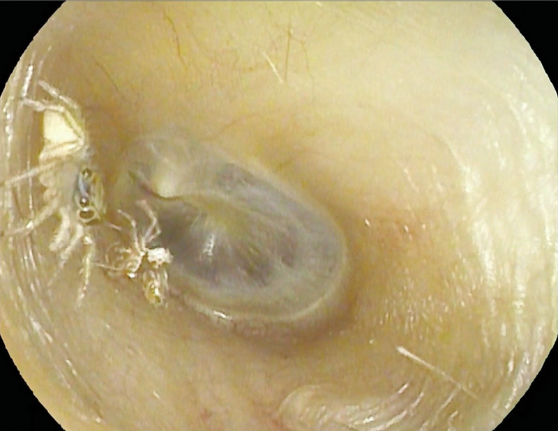 An image of a spider and it's exoskeloton in an ear canal